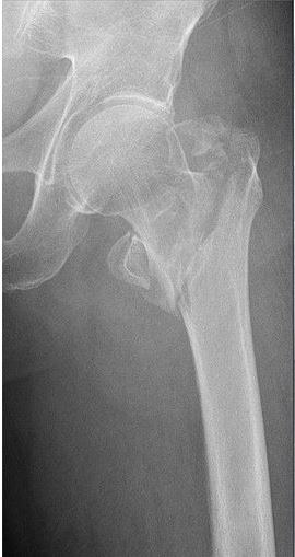Hip fracture, x-ray.