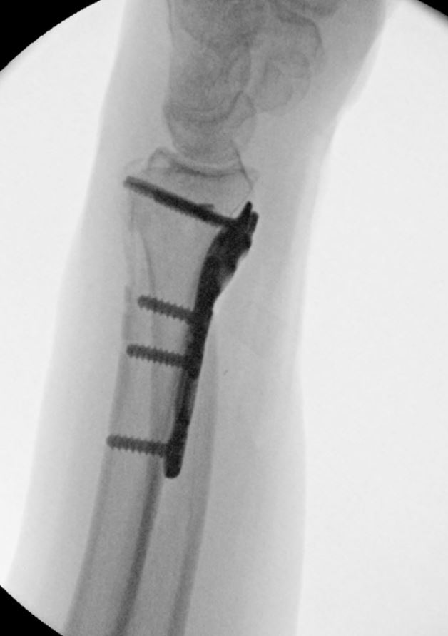 Hardware. Wrist digital radius fracture. Bones